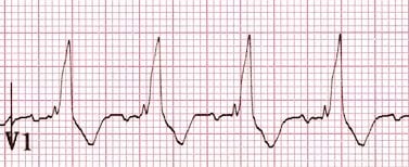 RBBB-typical-morphology