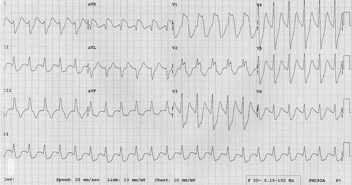 ECG Massive TCA overdose sodium channel toxicity 2