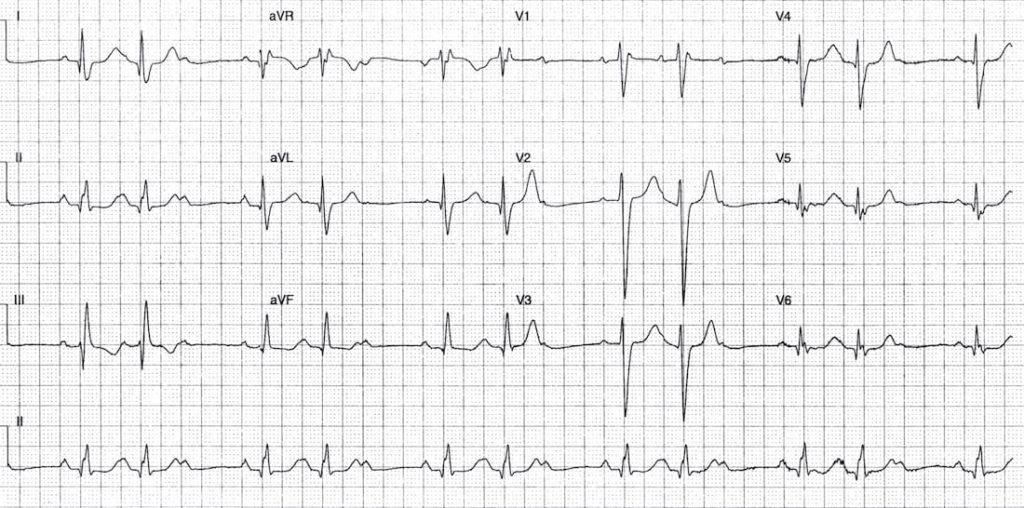 TOP 100 ECG QUIZ LITFL 043