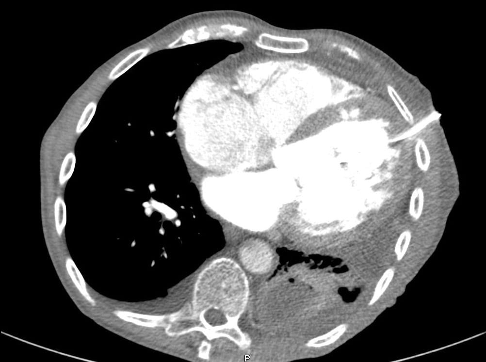 Chest drain intra-cardiac