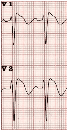 Brugada Sign V1 V2 ECG Coved St segments
