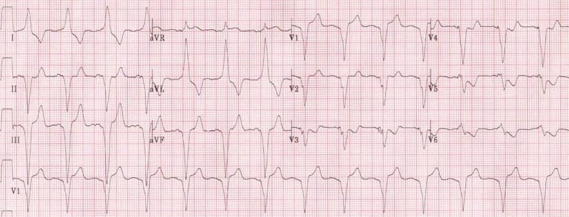 Left bundle branch block with T-wave inversion