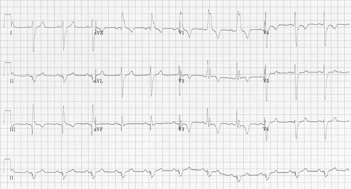 ECG Massive bilateral pulmonary embolus