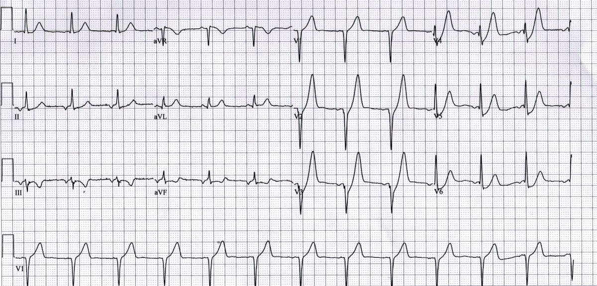 ECG De Winter T Waves 1