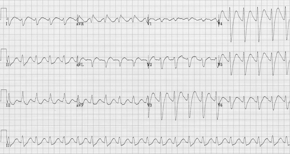 ECG TCA overdose Sodium Channel Blocking Agent Toxicity
