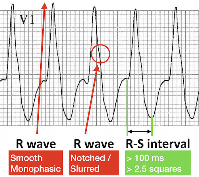 ECG VT V1 R wave RS interval RBBB morphology 700