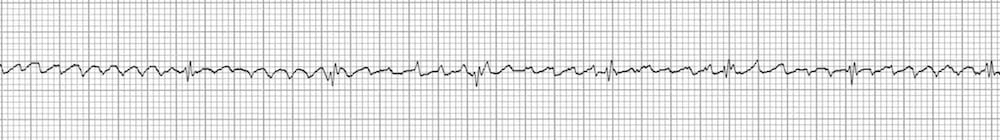 ECG Strip Flutter waves adenosine 2
