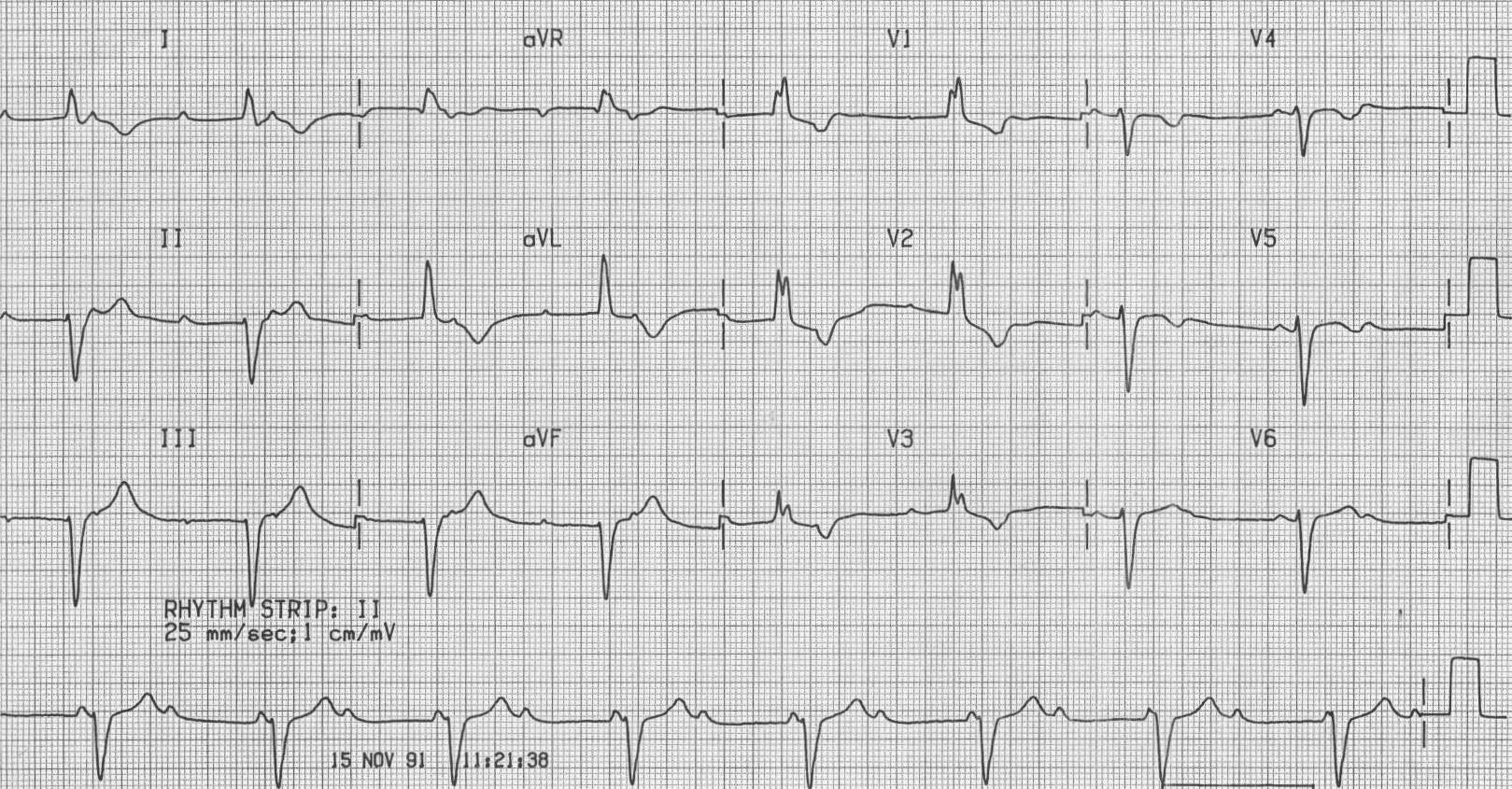 ECG90714 CHB RBBB Trifascicular