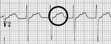Upright retrograde P waves in V2