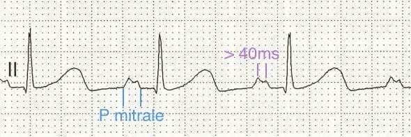 ECG strip bifid P wave p mitrale