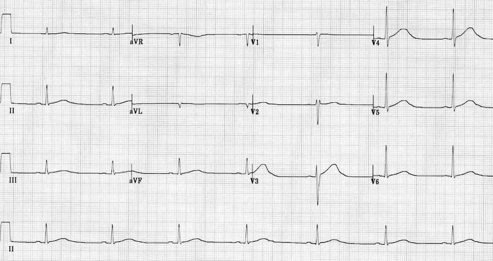 TOP 100 ECG QUIZ LITFL 023