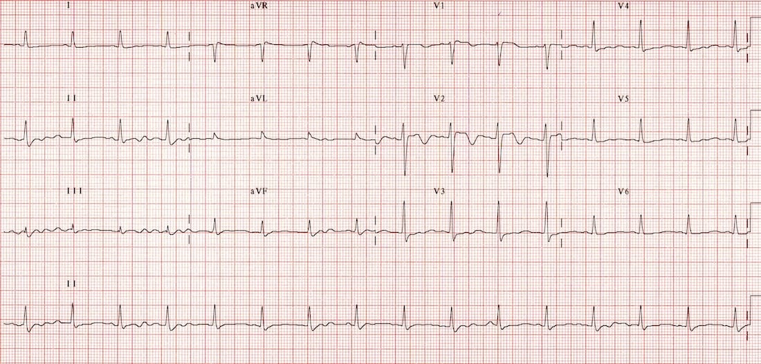 TOP 100 ECG QUIZ LITFL 056b