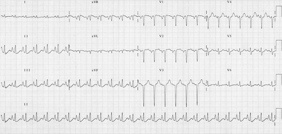 Pulmonary disease pattern COPD ECG