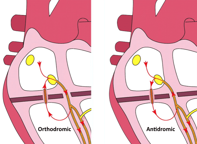 orthodromic-antidromic atrioventricular re-entrant tachycardia