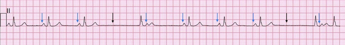 ECG Sino atrial block Type II