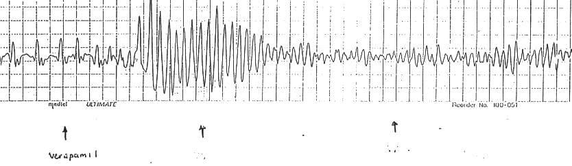 PVT-with-verapamil 2