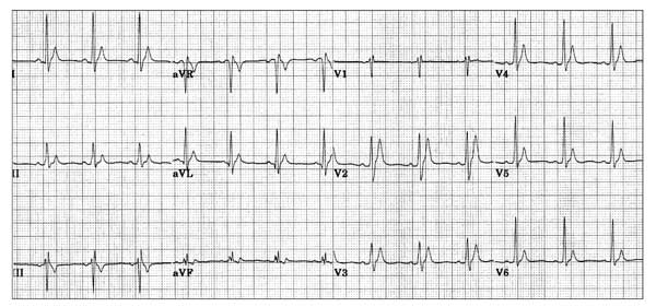 Congenital short QT syndrome SQTS