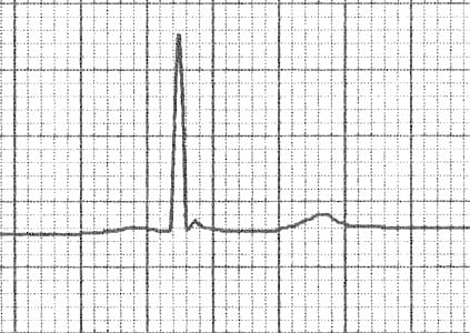 ECG Subtle Osborn wave J wave hypothermia