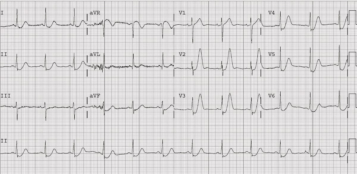 ECG De Winter T Waves 3