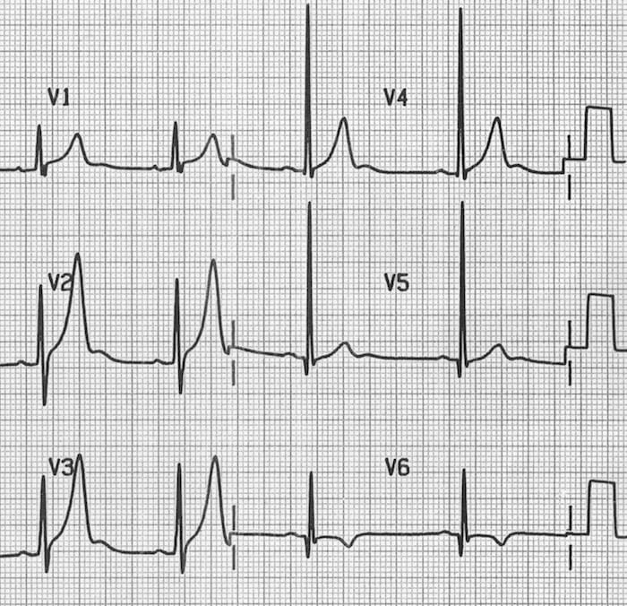 U waves associated with ventricular hypertrophy