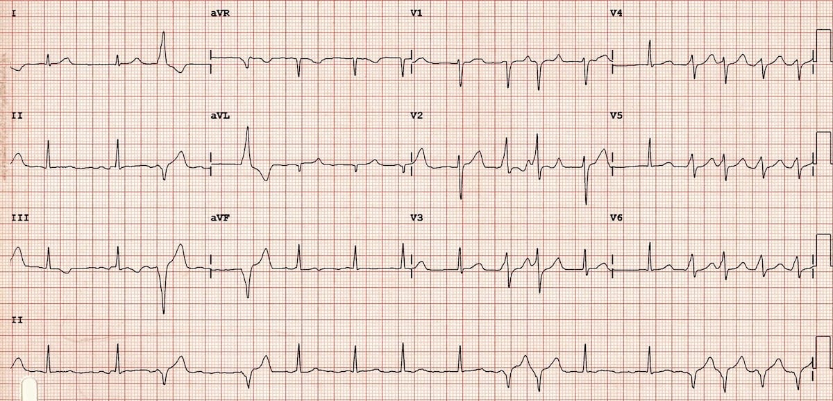 ECG WPW with intermittent pre-excitation