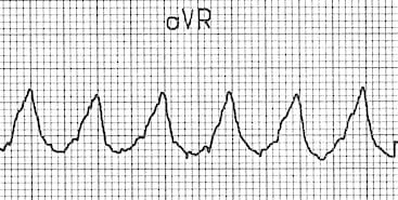 vereckei-aVR-VT Dominant initial R wave in aVR