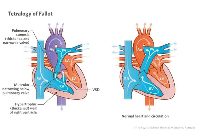 Tetralogy of Fallot
