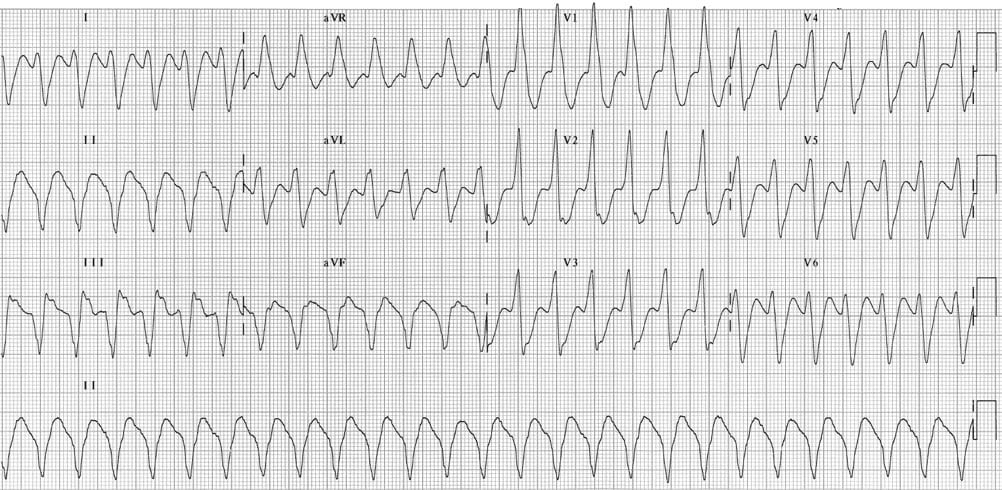 TOP 100 ECG QUIZ LITFL 046