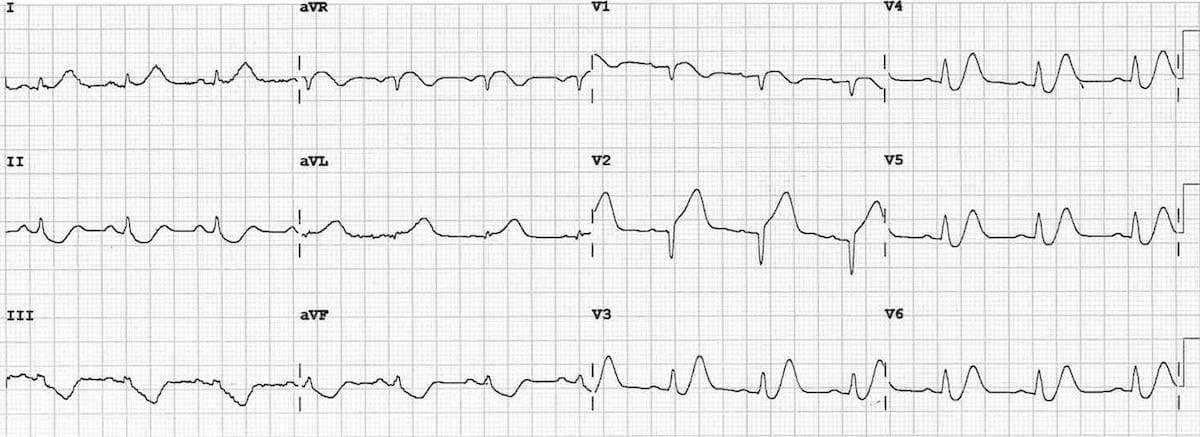 ECG De Winter T Waves 4
