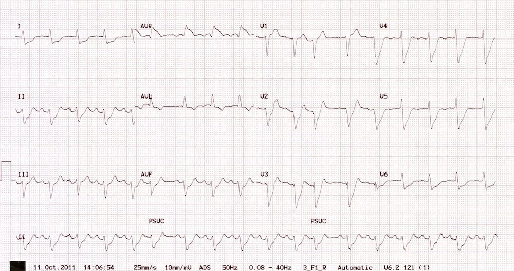 ECG Exigency 014