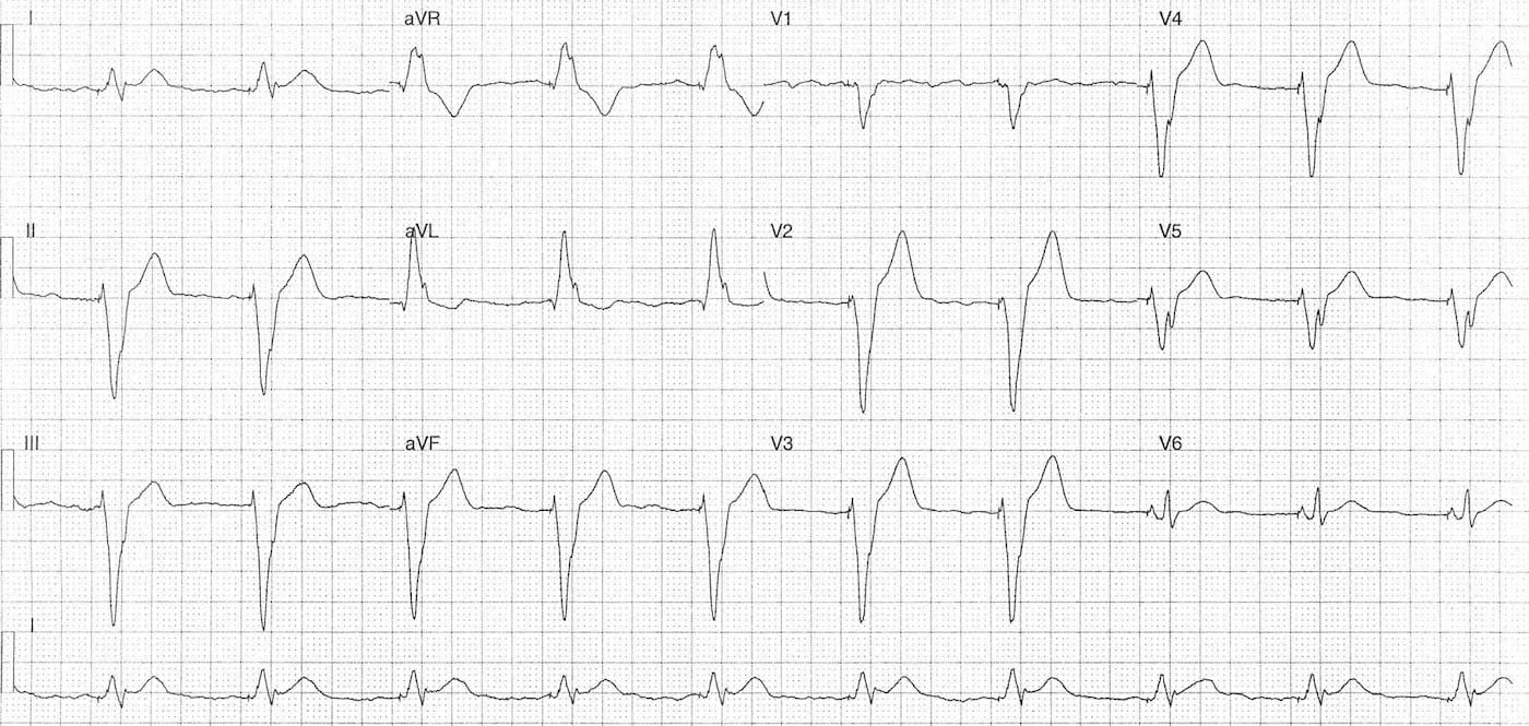 ECG Case 084a LITFL Top 100 EKG