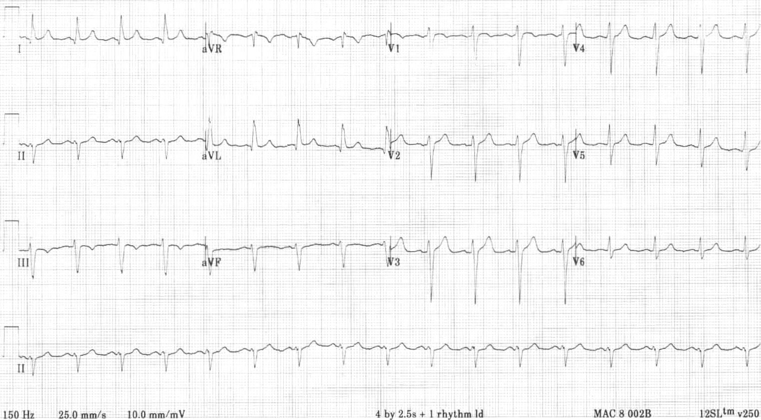 ECG 2 Left Anterior Fascicular Block (LAFB)