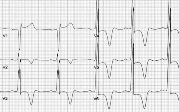 Apical HCM giant T wave inversion