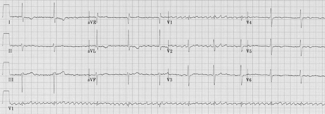 TOP 100 ECG QUIZ LITFL 054