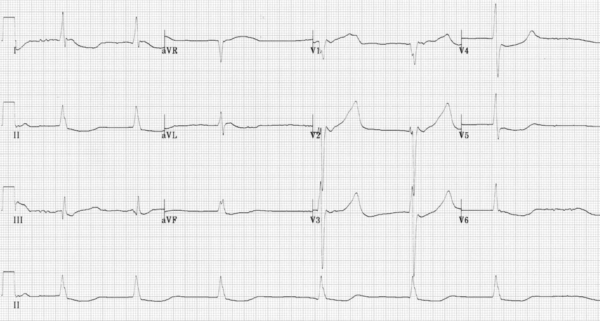 ECG Hypothermia slow atrial fibrillation AF