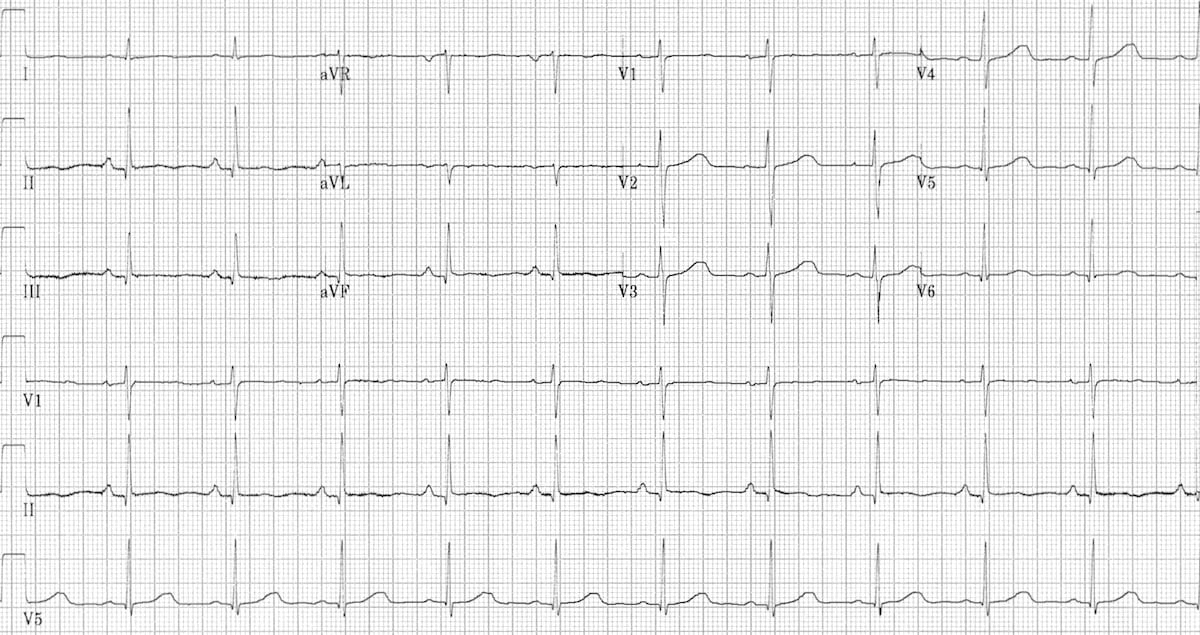 ECG Fast-Slow-3-resolved 2
