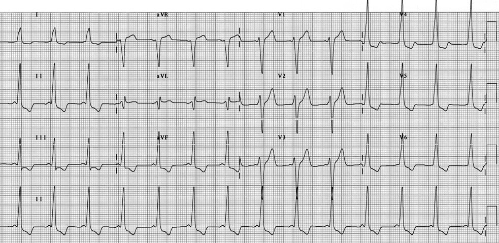 TOP 100 ECG QUIZ LITFL 037 2