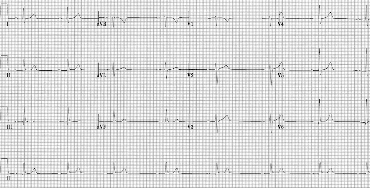 ECG Sinus bradycardia 1st degree AV block