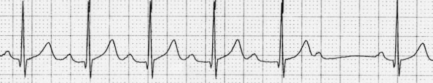 ECG Rhythm strip Mobitz I