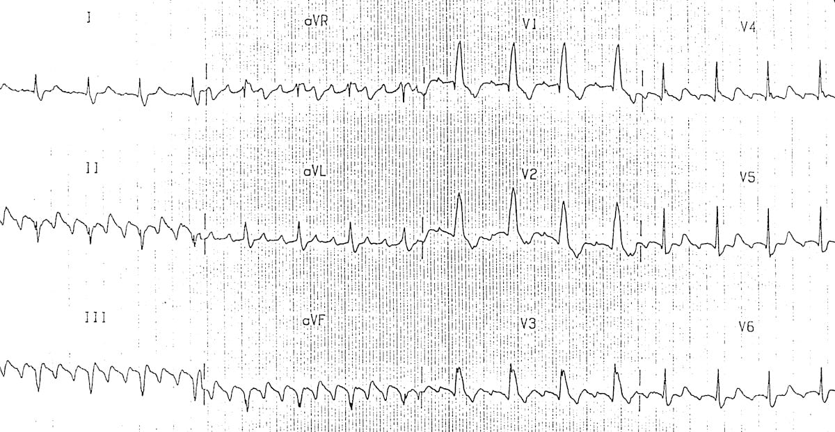 ECG Atrial flutter with Negative flutter waves