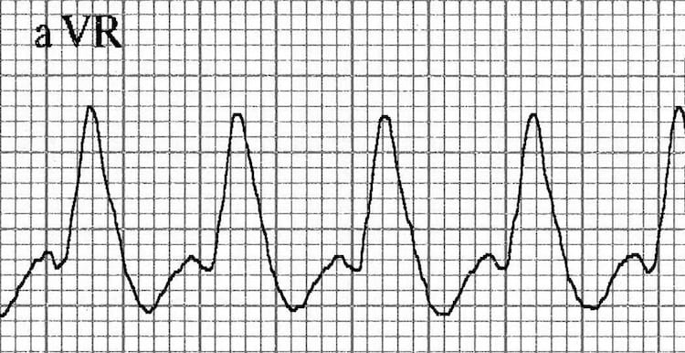 ECG VT Northwest Axis
