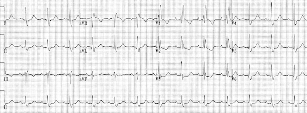 ECG Right Bundle Branch Block RBBB 5