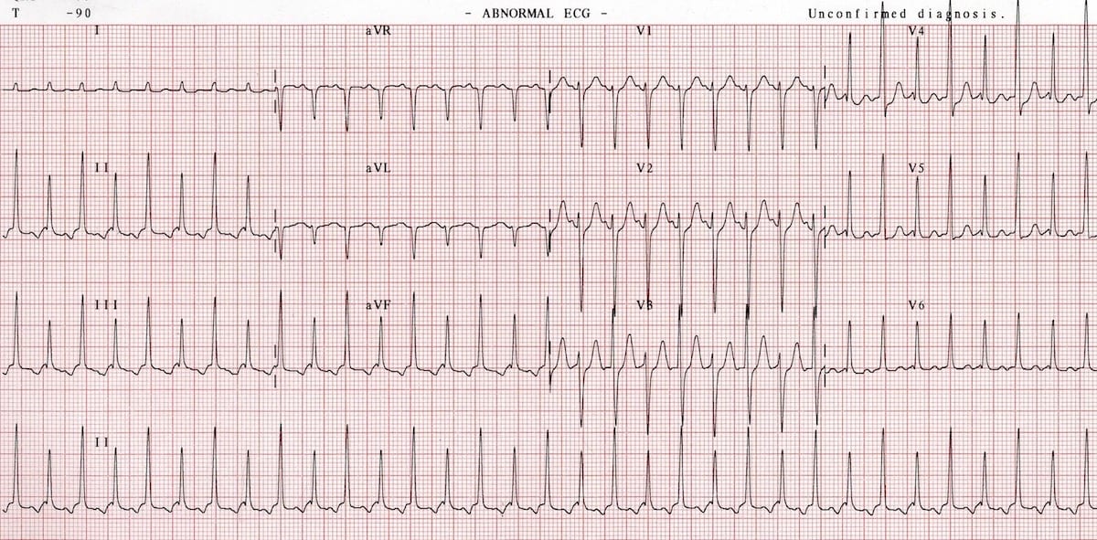 Electrical-alternans 2