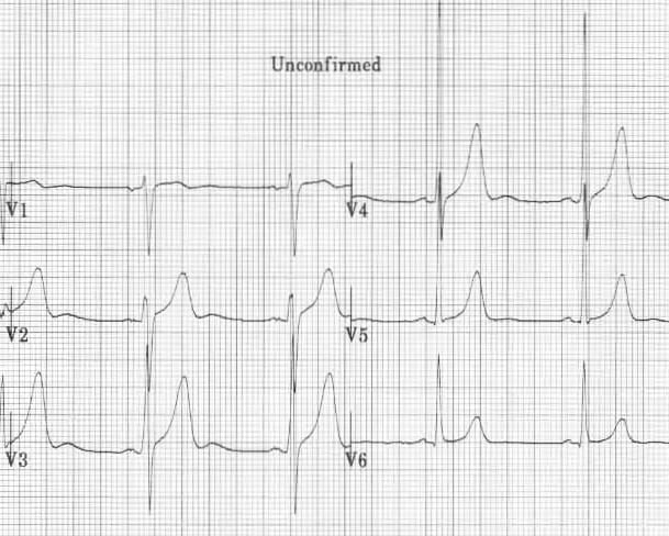 Prominent U waves due to sinus bradycardia