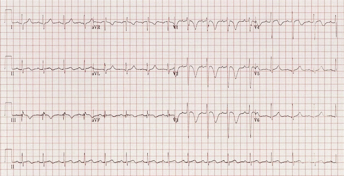 ECG Massive Pulmonary embolus RVH RV Strain
