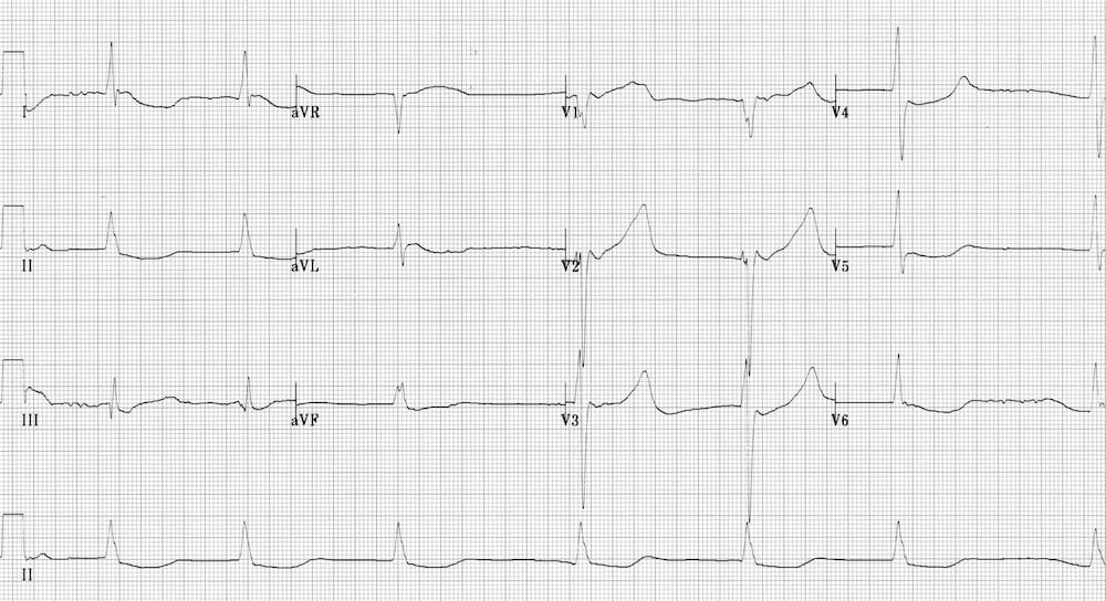 ECG hypothermia prolonged QTc