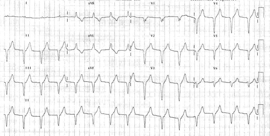 Accelerated Idioventricular Rhythm (AIVR) ECG 5