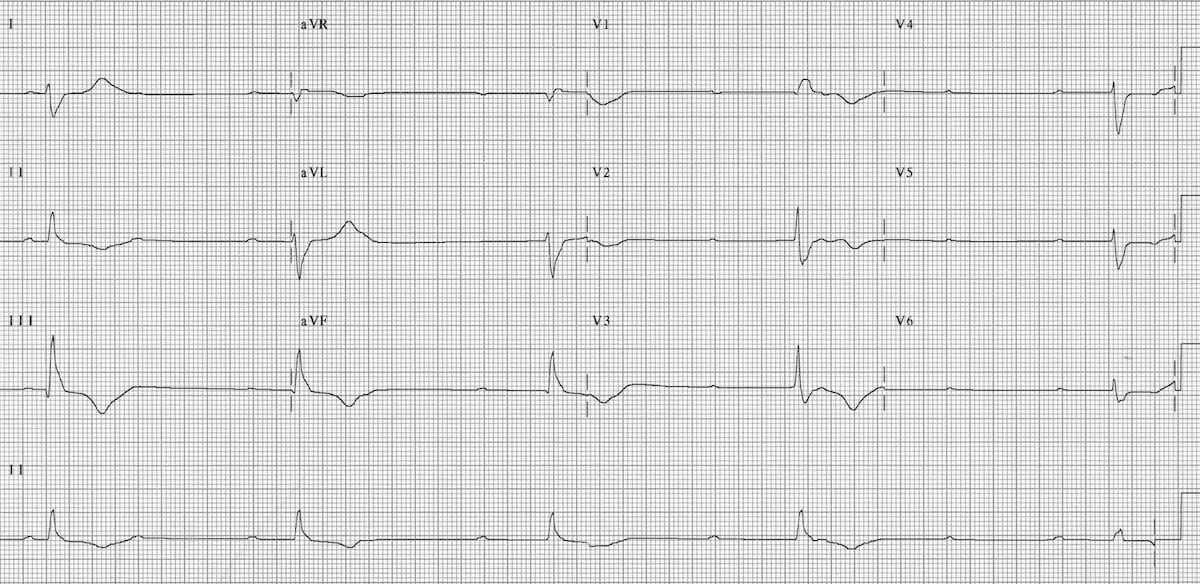 ECG Complete heart block CHB