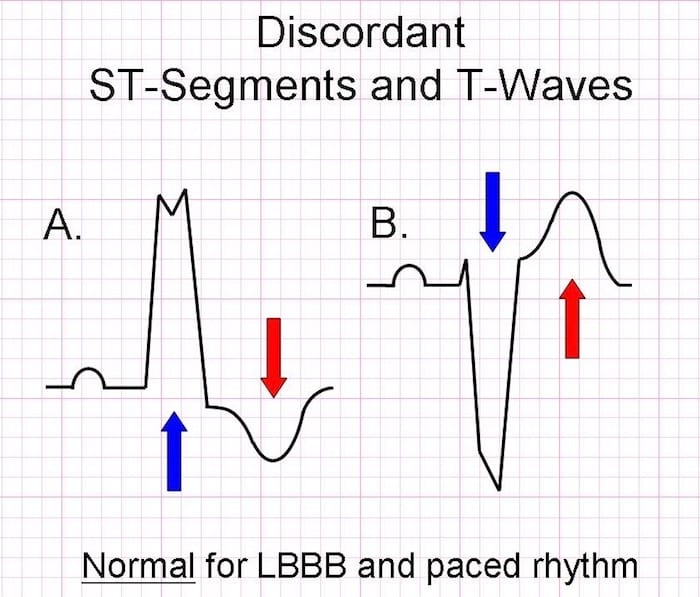 Sgarbossa criteria T-wave_discordance