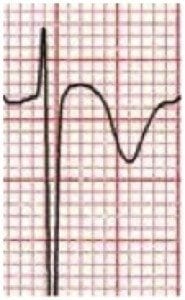 ECG Wellens Type 1 Complex